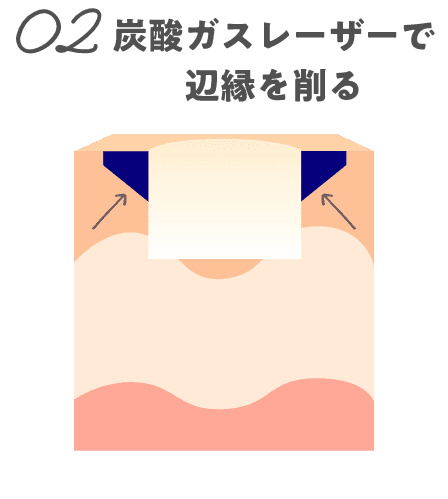 02炭酸ガスレーザーで辺縁を削る
