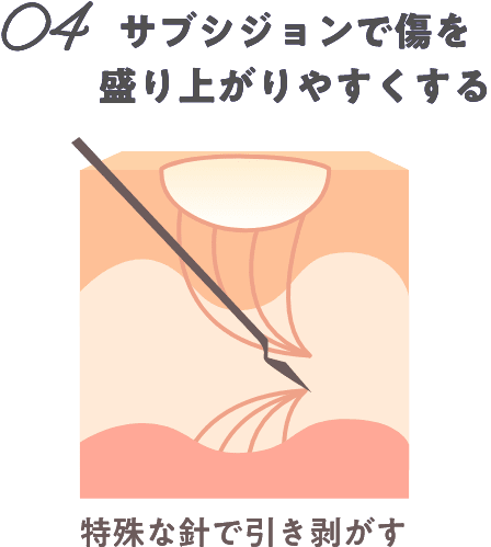 04サブ紙ジョンで傷を盛り上がりやすくする