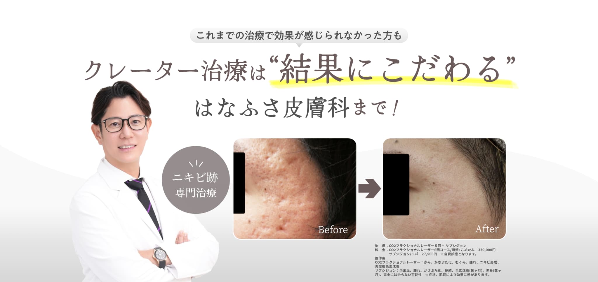 これまでの治療で効果が感じられなかった方もクレーター治療は”結果にこだわる”はなふさ皮膚科まで！