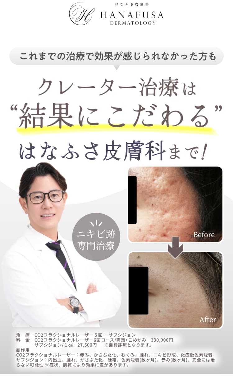 これまでの治療で効果が感じられなかった方もクレーター治療は”結果にこだわる”はなふさ皮膚科まで！