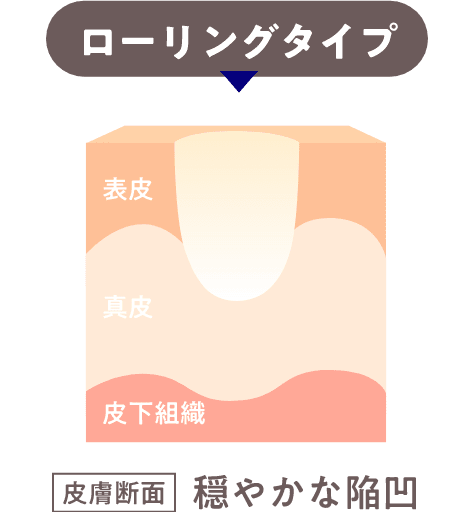 ローリングアイテム皮膚断面穏やかな陥凹