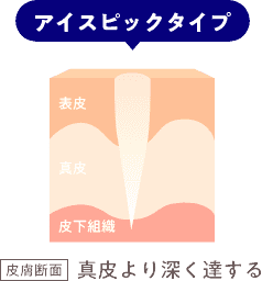 アイスピックタイプ皮膚断面真皮より深く達する