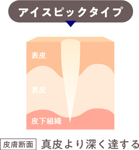 アイスピックタイプ皮膚断面真皮より深く達する