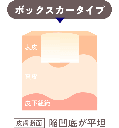 ボックスカータイプ皮膚断面陥凹底が平坦