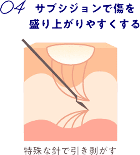 04サブ紙ジョンで傷を盛り上がりやすくする